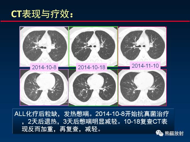 大爷节前大扫除后感染肺曲霉病，警惕生活中的健康隐患