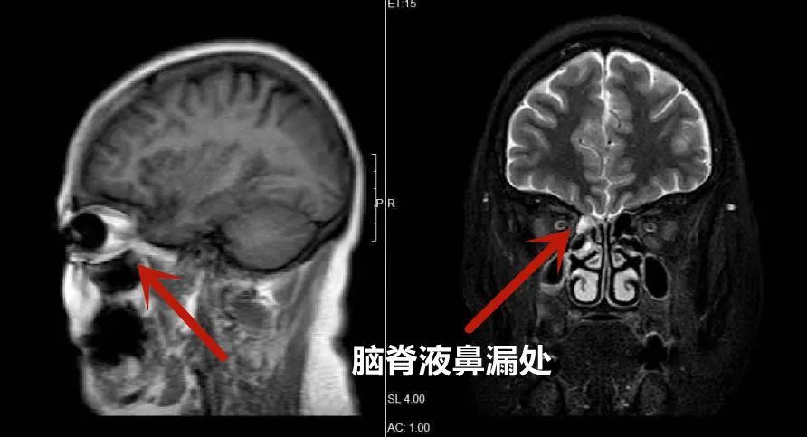 女子没感冒却持续流鼻涕，真相竟是脑脊液泄漏之谜